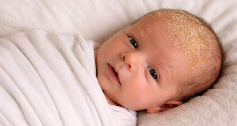 come togliere crosta lattea neonati