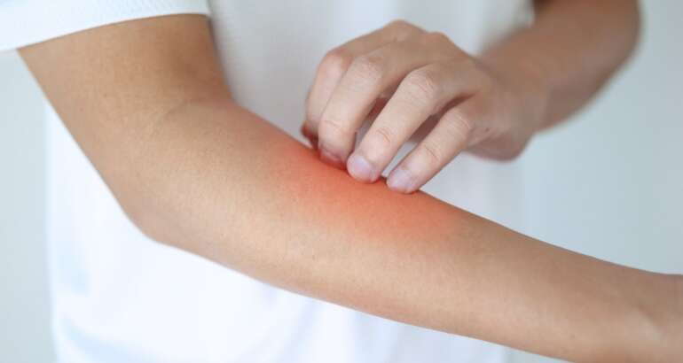 amido di riso per dermatite adulti